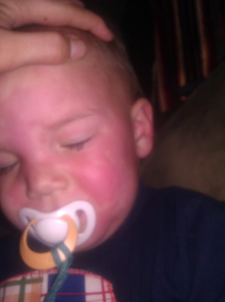 toddler cheek rash